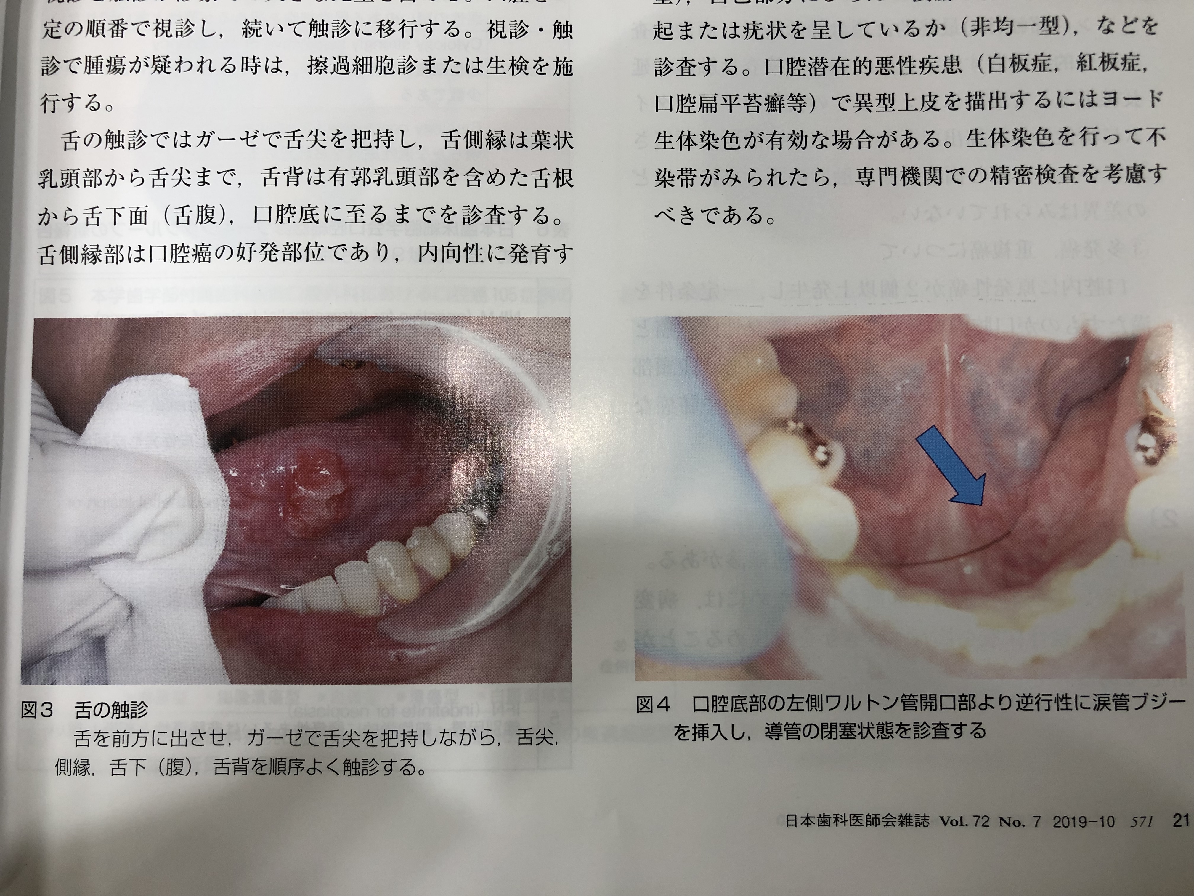 早期発見 口腔癌 新大久保歯科医院